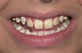 dental fluorosis.