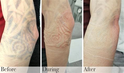 Laser Tattoo Removal in Reading | DrBK Medical Aesthetics Clinic