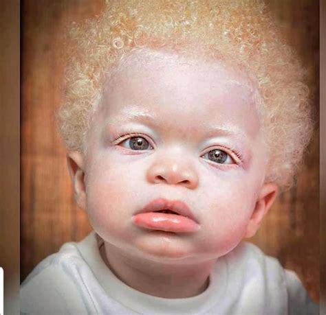 Albino baby😻 | Beautiful children, Albino, Black baby boys