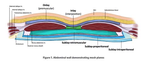 Mesh placement in ventral hernia repair | Surgical Focus