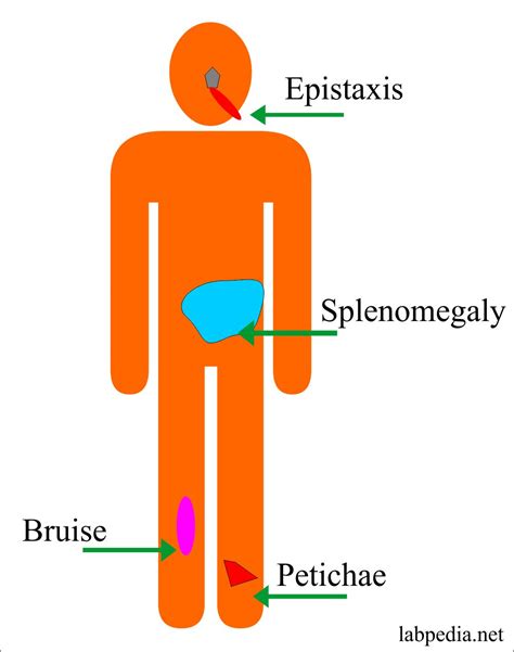 Polycythemia (Erythrocytosis), Polycythemia Rubra Vera, and Secondary Polycythemia - Labpedia.net