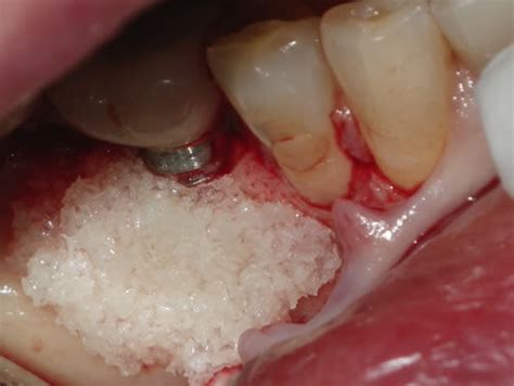 Dental Implant Complications NYC | Dental Implant Problems