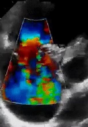 Color flow Doppler (ultrasound) | Radiology Reference Article ...