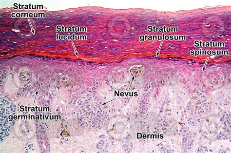 Man. Compound nevus. Vertical section. 125X - Nevus - Mammals - Integumentary system ...