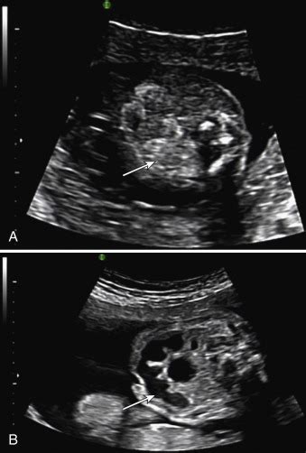 Echogenic Bowel | Radiology Key