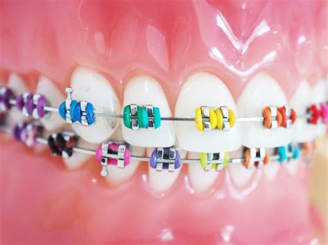 Braces Color Wheel: How to Pick the Best Braces Colors for Your Teeth - Golden Health Centers