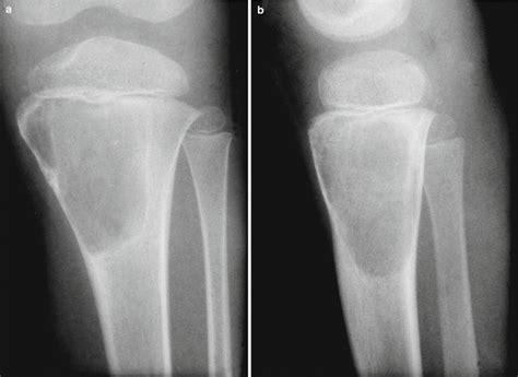 Simple Bone Cyst | Musculoskeletal Key