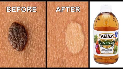 Mole Removal By Apple Cider Vinegar || Effective Ways to Remove Skin ...