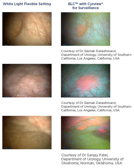 Blue Light Cystoscopy Cost | Shelly Lighting