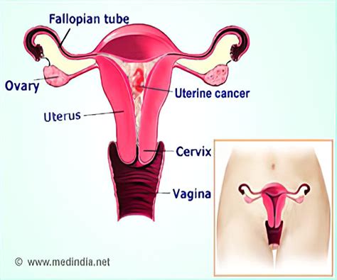 Endometrial Cancer Symptoms