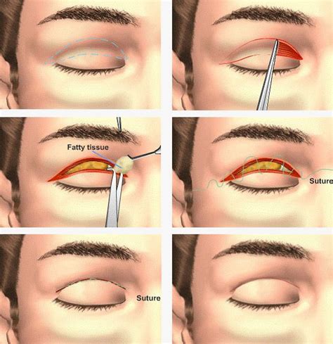 Upper Blepharoplasty Procedure. For the lower eyelids | cosmetic ...