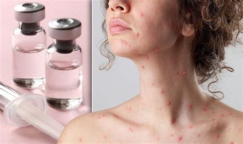 Is there a chicken pox vaccine? | Express.co.uk