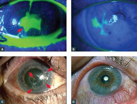 Corneal Ulcer