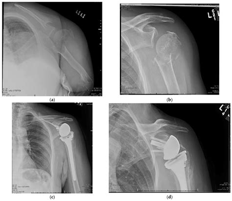 Mechanisms Of Humeral Head Fracture