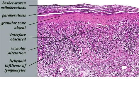 lichen planus histology - pictures, photos