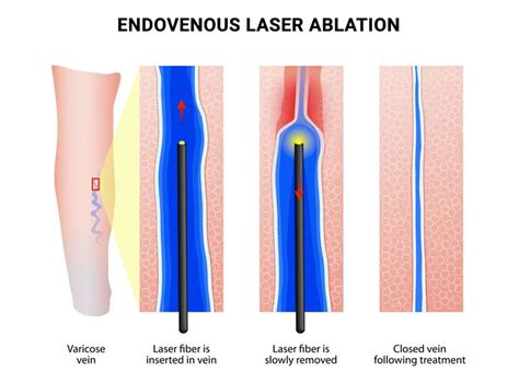 Endovenous Laser Ablation (EVLA, EVLT) - Vein & Endovascular Medical Care