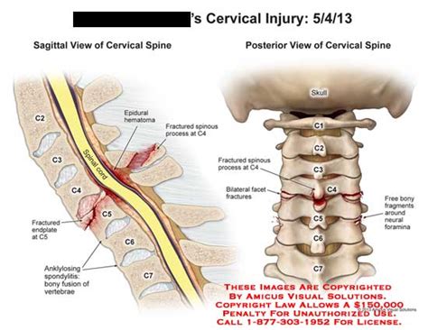 AMICUS Illustration of amicus,injury,cervical,spinal,cord,C2,C3,C4,C5 ...