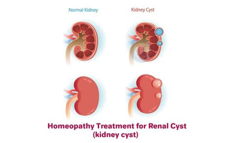 17 Best Kidney Cysts Home Remedies : Homenaturalcures