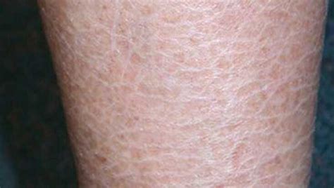 Disease Ichthyosis Vulgaris | AI Care