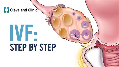 How Does In Vitro Fertilization (IVF) Work? A Step-by-Step Explanation ...