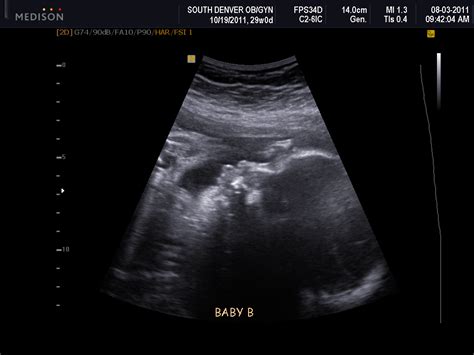 A Road Well Traveled: 29 Week Ultrasound