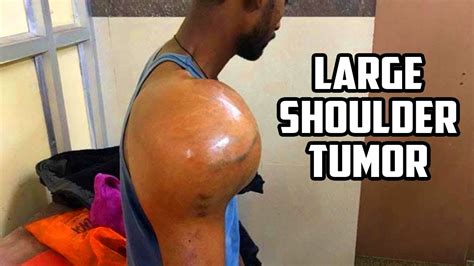 Osteosarcoma - Large Shoulder Tumor Case Study - YouTube