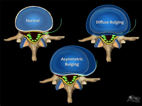 Foraminal Disc Protrusion Treatment - Captions Beautiful