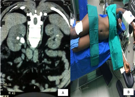 Laparoscopic Pyelolithotomy: Initial Experience with 62 Patients