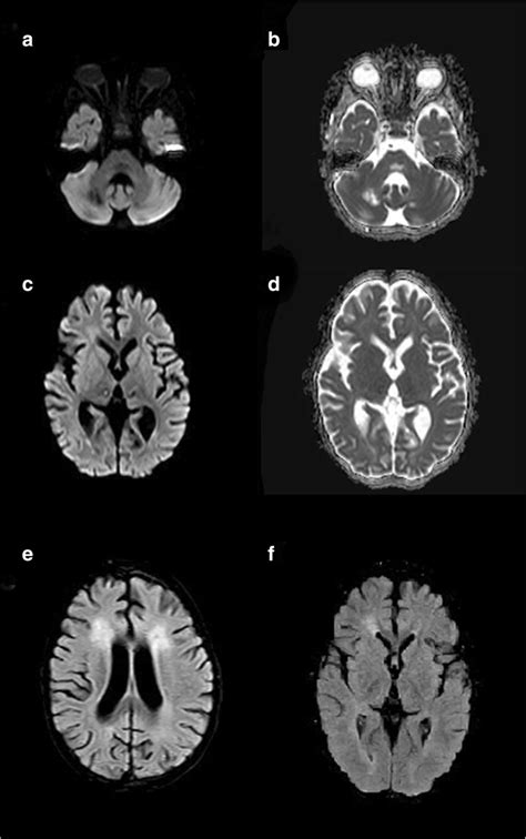 The brain MRI performed 5 months later for epilepsy showed low signal... | Download Scientific ...