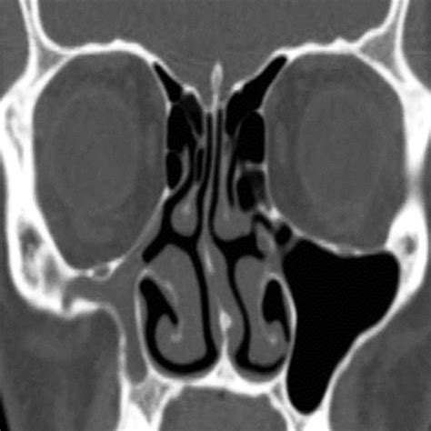 CT scan of paranasal sinus — axial view showing normal ethmoid sinus | Download Scientific Diagram