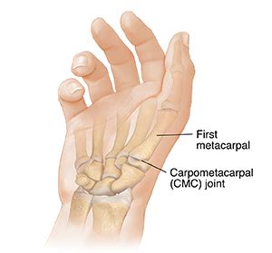 Understanding Bennett Fracture | Saint Luke's Health System