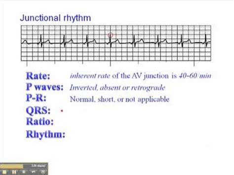 Junctional Rhythm