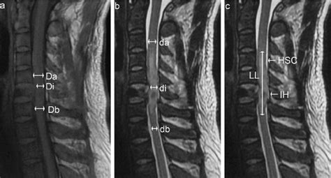 A 29-year-old man suffered a C6 fracture and ASIA grade A injury during... | Download Scientific ...