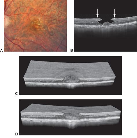 Lamellar macular hole - American Academy of Ophthalmology