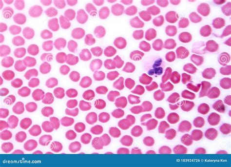Blood Smear Of A Patient With Malaria Plasmodium Falciparum Royalty-Free Stock Image ...