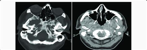 Repeat axial CT scan showing bony erosion around the clivus and foramen... | Download Scientific ...