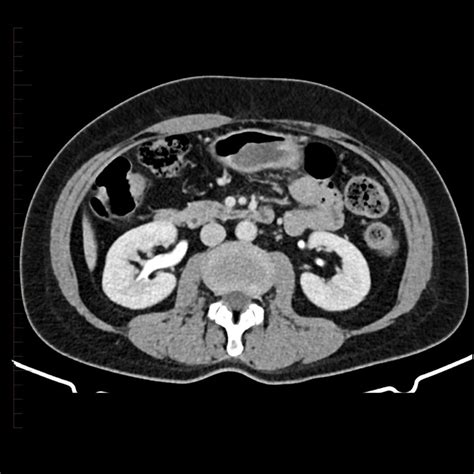 CT Scan of the Kidney - Diagnostic Imaging - Melbourne Radiology