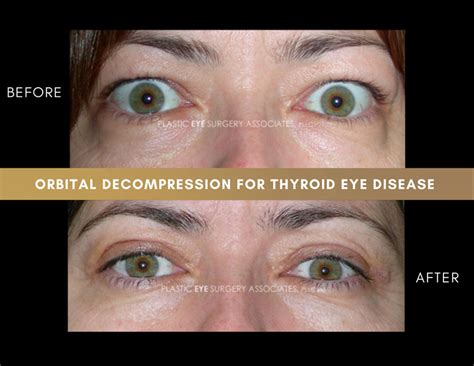 Thyroid Eye Disease Photos - Plastic Eye Surgery Associates