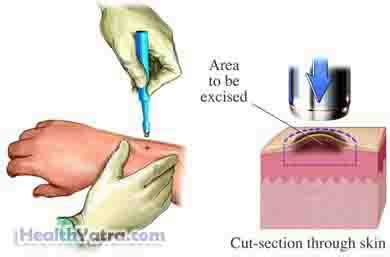 Xanthelasma and Xanthoma for Skin Treatment in India