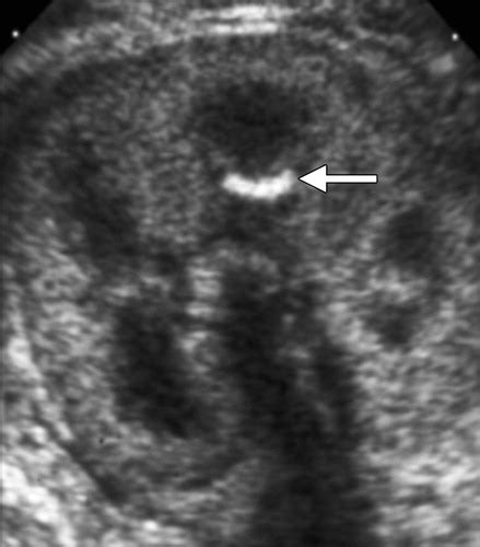 Renal Pyramids Ultrasound