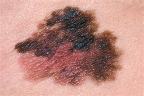 Skin cancer (melanoma) - NHS.UK