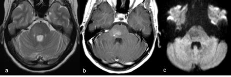 Capillary telangiectasia of the brainstem: MR features