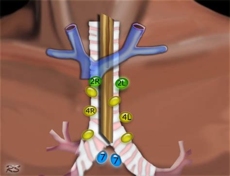 The Radiology Assistant : Mediastinal Lymph Node Map (2023)