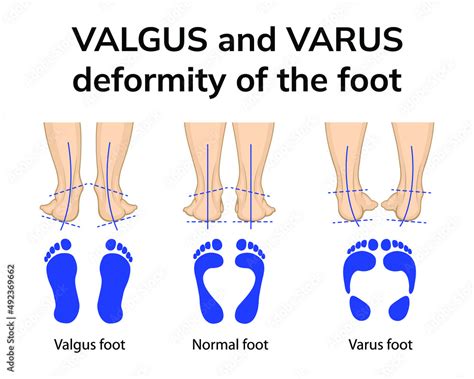 Vetor de Illustration of the position of the feet in varus and valgus deformities. Depicted is a ...