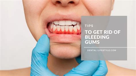 Tips to Get rid of Bleeding Gums | oral health tips & ticks | dental ...