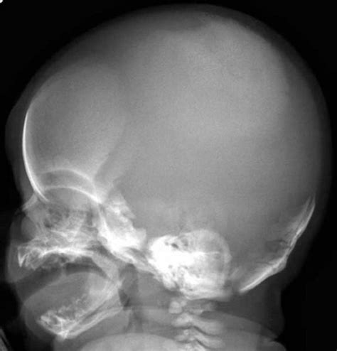 Craniodiaphyseal Dysplasia Skull