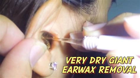 Very Dry Giant Earwax Removal - YouTube