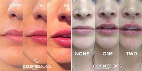 Lip Fillers Before and After Photos at CosmeDocs for Natural or Bold Lips