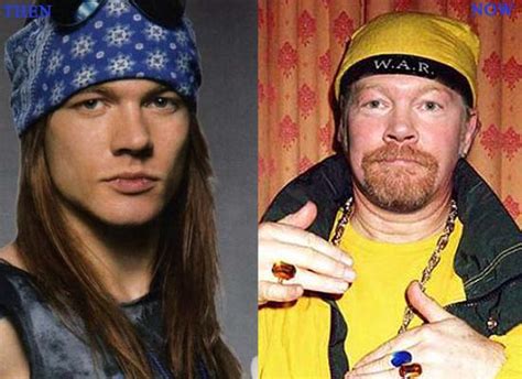 Axl Rose Plastic Surgery Photo Before and After - CELEB-SURGERY.COM