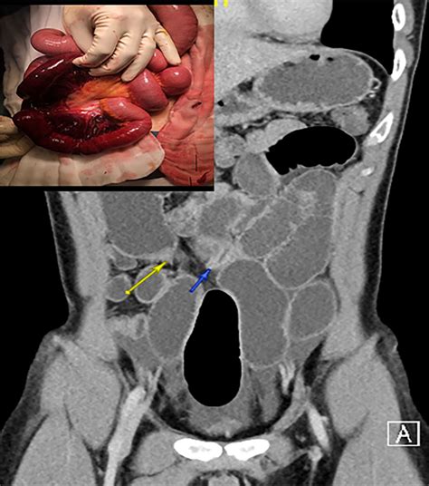 Adhesive small bowel obstruction – an update - Tong - 2020 - Acute ...